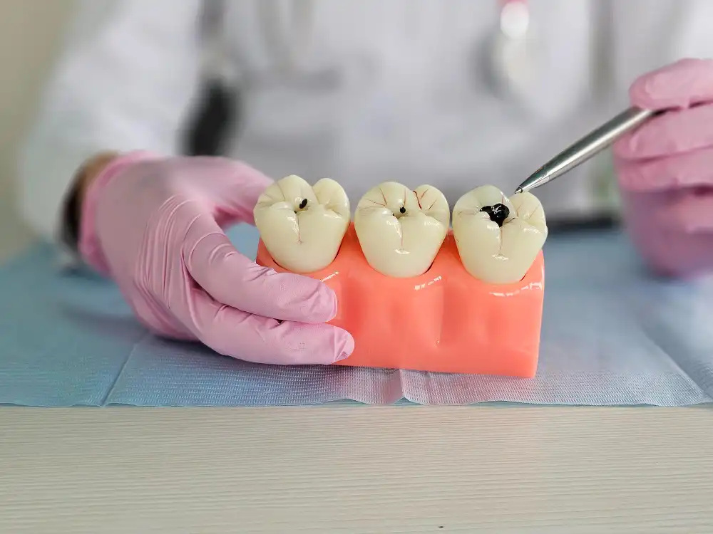 Composite Fillings | Pure Dental Repair & Care